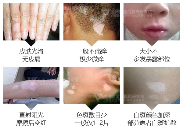 白癜风的症状表现