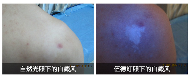 如何区分白斑是不是白癜风呢？